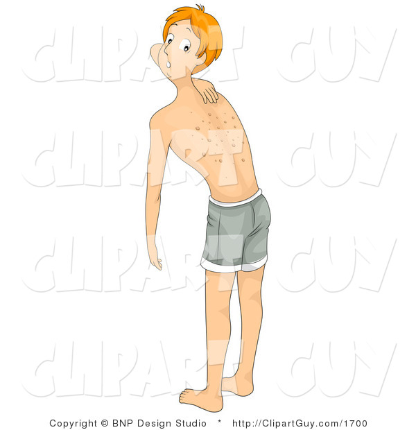 Vector Clip Art of a Man with an Allergic Reaction on His Back - Royalty Free